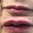 Powiększanie ust kwasem hialuronowym przed i po zabiegu