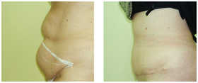 Plastyka ciała (body lifting) przed i po zabiegu