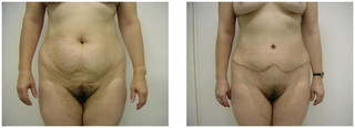Plastyka ciała (body lifting) przed i po zabiegu
