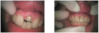 Protetyka stomatologiczna przed i po zabiegu
