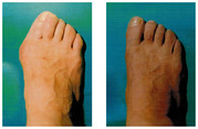 Operacje i leczenie stopy / stawu skokowego przed i po zabiegu