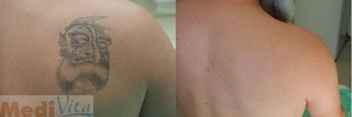 Laserowe usuwanie tatuaży przed i po zabiegu