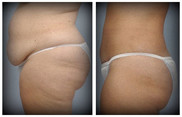 Chirurgia plastyczna ciała i modelowanie sylwetki przed i po zabiegu