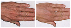 Dłonie -  lifting laserem przed i po zabiegu