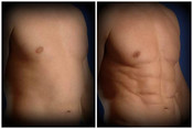 Liposukcja - odsysanie tłuszczu przed i po zabiegu