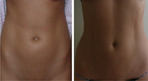 Liposukcja ultradźwiękowa Vaser Lipo HD - modelowanie sylwetki przed i po zabiegu