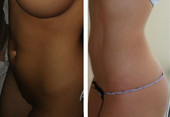 Liposukcja ultradźwiękowa Vaser Lipo HD - modelowanie sylwetki przed i po zabiegu