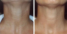 Mezoterapia igłowa przed i po zabiegu