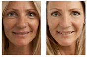 Mezoterapia - odmładzanie i rewitalizacja skóry przed i po zabiegu