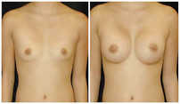 Operacje plastyczne piersi przed i po zabiegu