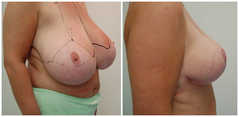 Operacje plastyczne piersi przed i po zabiegu