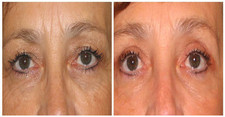 Operacje plastyczne powiek przed i po zabiegu