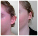Operacje plastyczne uszu przed i po zabiegu