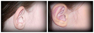 Operacje plastyczne uszu przed i po zabiegu