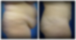 Plastyka brzucha przed i po zabiegu