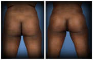 Plastyka ciała (body lifting) przed i po zabiegu