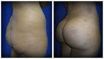 Plastyka ciała (body lifting) przed i po zabiegu