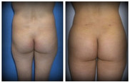 Plastyka ciała (body lifting) przed i po zabiegu