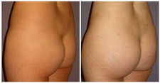 Plastyka pośladków przed i po zabiegu
