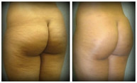 Plastyka pośladków przed i po zabiegu