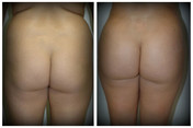 Plastyka pośladków przed i po zabiegu