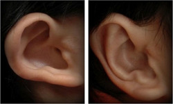 Plastyka zwiniętych uszu przed i po zabiegu