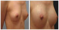 Powiększanie piersi przed i po zabiegu