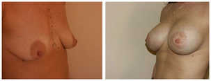 Powiększanie piersi przed i po zabiegu