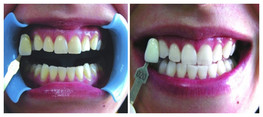 Wybielanie zębów w Albus Dent - zdjęcie przed i po zabiegu
