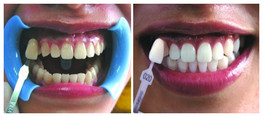 Wybielanie zębów w Albus Dent - zdjęcie przed i po zabiegu