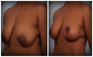 Zmniejszenie piersi przed i po zabiegu
