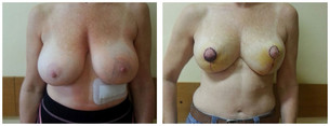 Zmniejszenie piersi przed i po zabiegu