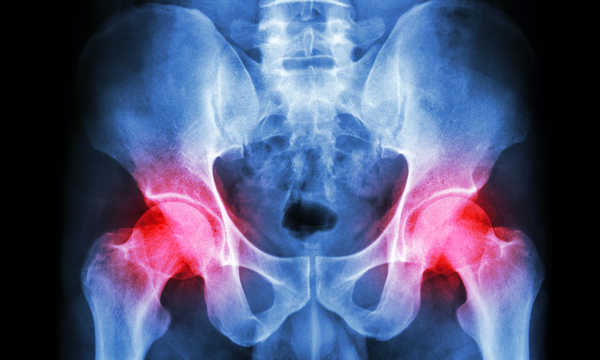 Podanie do stawu biodrowego osocza bogatopłytkowego z tłuszczem bogatym w komórki macierzyste to nowoczesna, małoinwazyjna metoda wspomagająca regenerację tkanek stawowych