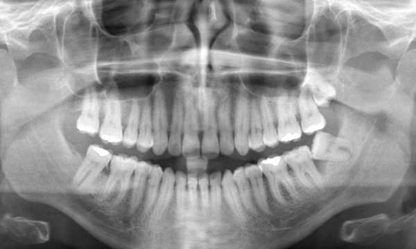 Tomografia CBCT 3D w stomatologii