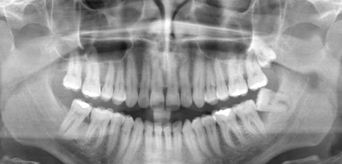 Tomografia CBCT 3D w stomatologii