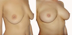Powiększanie piersi Aquafilling Bodyline przed i po zabiegu