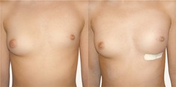 Powiększanie piersi Aquafilling Bodyline przed i po zabiegu