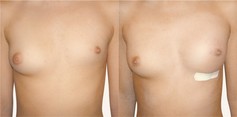 Powiększanie piersi Aquafilling Bodyline przed i po zabiegu