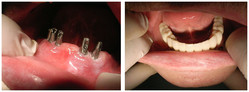 Implantologia przed i po zabiegu