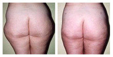 Liposukcja okolic biodrowych przed i po zabiegu