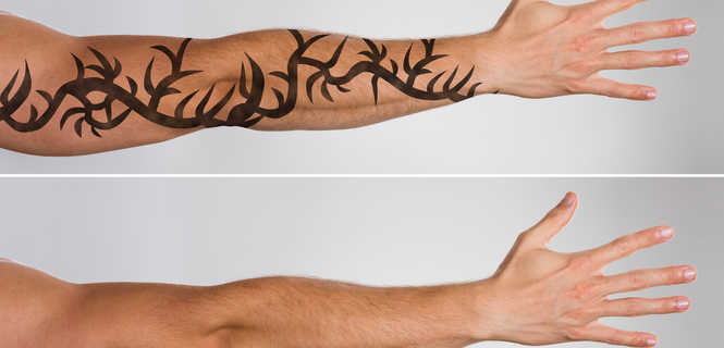 Metody usuwania tatuaży