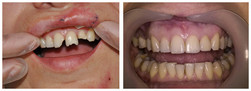 Odbudowa złamanego zęba przed i po zabiegu