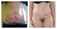 Plastyka ciała (body lifting) przed i po zabiegu