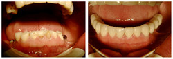 Proteza zębowa stabilizowana na 4 implantach przed i po zabiegu