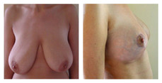Zmniejszenie piersi przed i po zabiegu