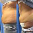 Liposukcja - odsysanie tłuszczu przed i po zabiegu