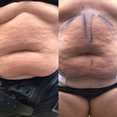 Liposukcja - odsysanie tłuszczu przed i po zabiegu