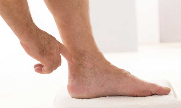 Skleroterapia żylaków pod kontrolą USG to nowoczesna, mało inwazyjna metoda leczenia niewydolności żylnej, która pozwala na precyzyjne podanie środka obliterującego bezpośrednio do zmienionych naczyń