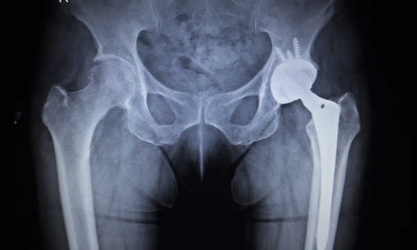 Regeneracja po operacji biodra