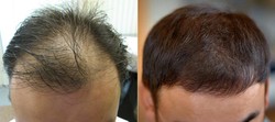 Zabiegi przeszczepiania włosów przed i po zabiegu